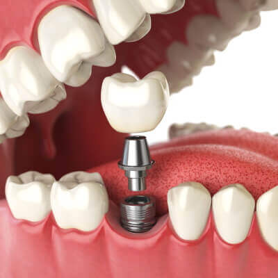 Tratamientos - Implantes Dentales